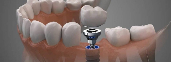 انواع روش های ایمپلنت | تکنا 2 اندوستیال