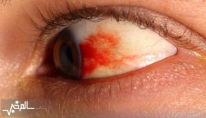 دو بیماری رتینوپاتی دیابتی و استحاله شبکیه بیماران دیابتی را تهدید می‌کند