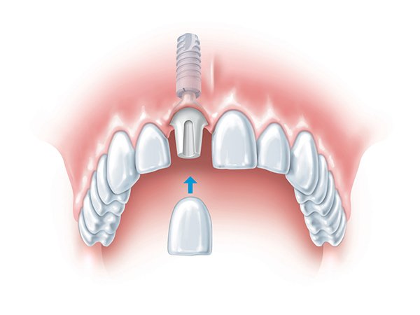 مزایای کاشت دندان جلو