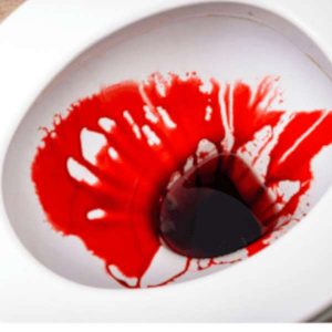 عکس واقعی از بواسیر خونی + خونریزی بواسیر 2 2 20