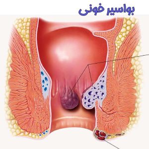 عکس واقعی از بواسیر خونی + خونریزی بواسیر