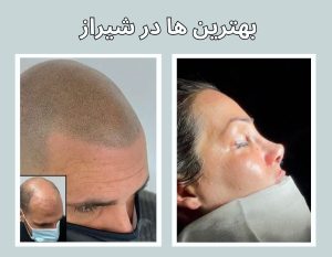 چرا شیراز مقصد اول برای عمل بینی و کاشت مو است؟