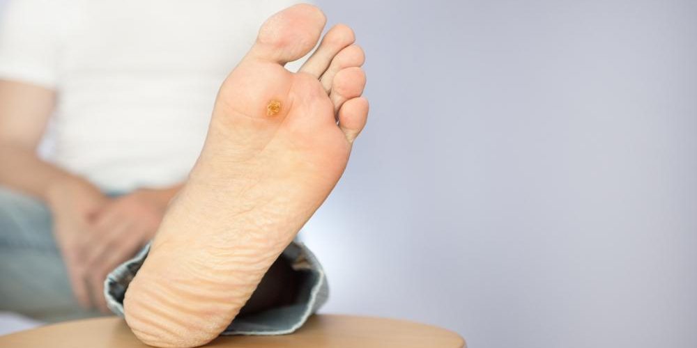 زخم پای دیابتی چگونه است؟ 2 زخم پای دیابتی چگونه است؟