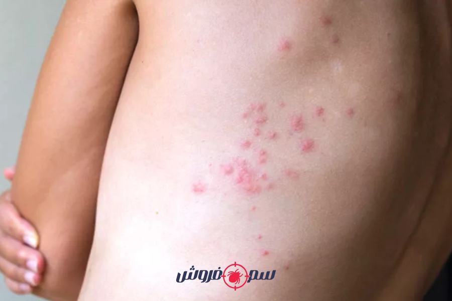 حشره ساس چیست؟ سم مخصوص ساس 3 علائم وجود ساس در خانه - جای نیش ساس