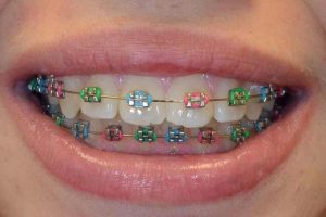 بهترین رنگ برای کش ارتودنسی برای دختر و پسر: جذابیت در هر لبخند