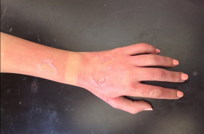 آشنایی با درجه های سوختگی و روش های درمان آن