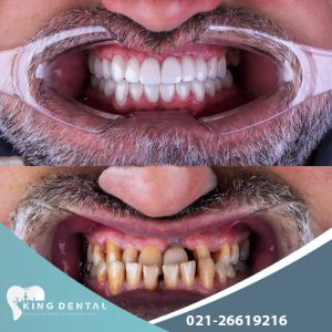 مرکز ایمپلنت دندان در سعادت آباد 09002012050