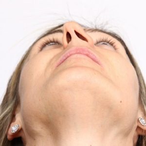 ایا عمل انحراف بینی باعث زیبایی میشود؟