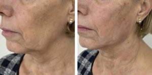 مزایا و کاربردهای اندولیفت