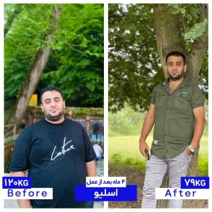 تجربه مشترک افراد قبل از انجام عمل اسلیو معده