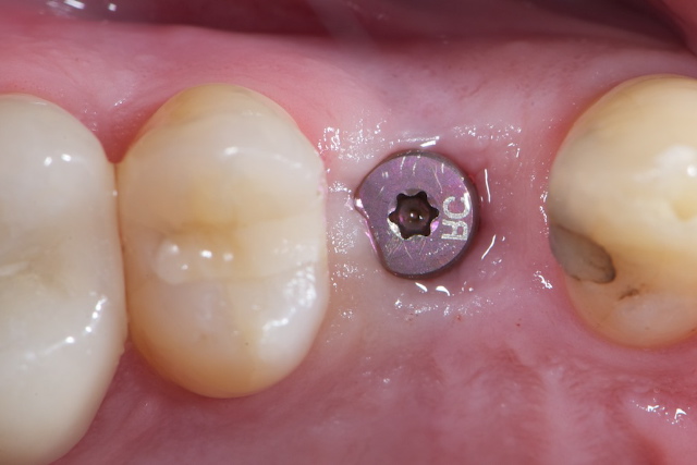 کاشت ایمپلنت دندان به روش پانچ