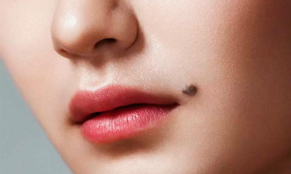 راهنمای جامع برداشتن خال صورت با دستگاه لیزر در کلینیک زیبایی عاشوری 2 2 21