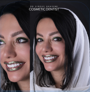 بهترین مرکز لمینت فوری دندان همراه با نمونه کار واقعی