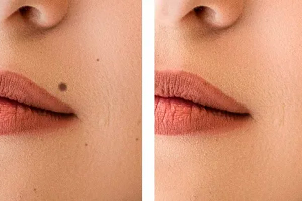 راهنمای جامع برداشتن خال صورت با دستگاه لیزر در کلینیک زیبایی عاشوری 3 3 13