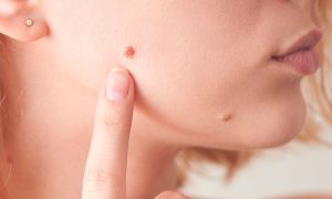 راهنمای جامع برداشتن خال صورت با دستگاه لیزر در کلینیک زیبایی عاشوری