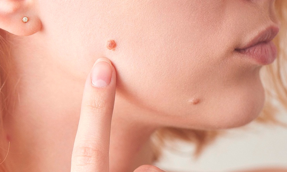 راهنمای جامع برداشتن خال صورت با دستگاه لیزر در کلینیک زیبایی عاشوری