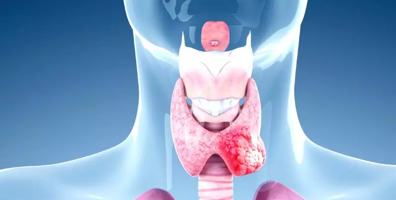 سرطان تیروئید [ علائم، تشخیص ، درمان + جراحی ]