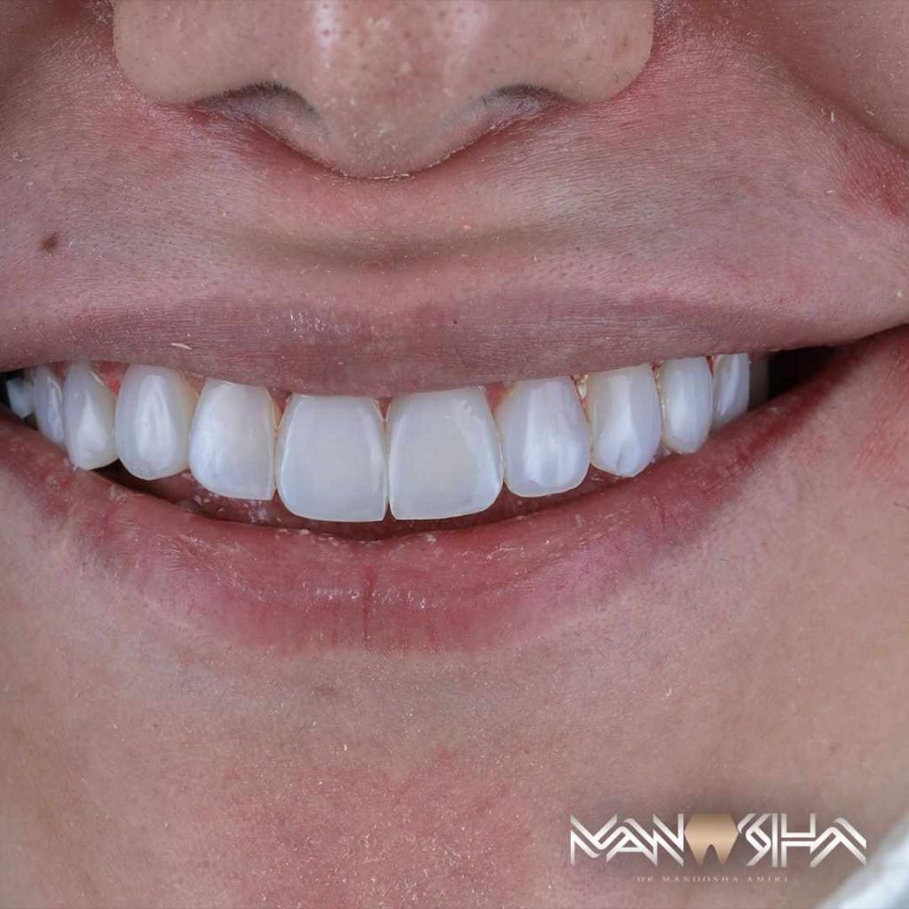 قیمت کامپوزیت دندان در سال 1403 3 قیمت کامپوزیت دندان در سال 1403