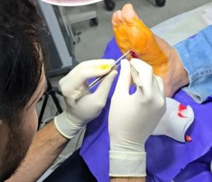 چه طور از شر میخچه پا راحت شویم؟