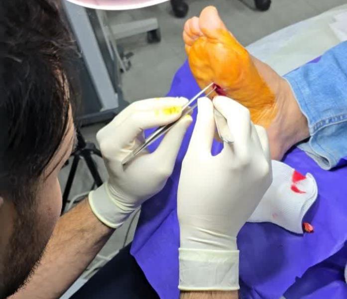 چه طور از شر میخچه پا راحت شویم؟