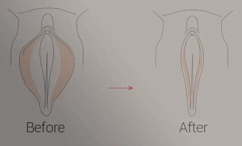 تنگ کردن واژن با نخ: راهی برای بازیابی سلامت جنسی