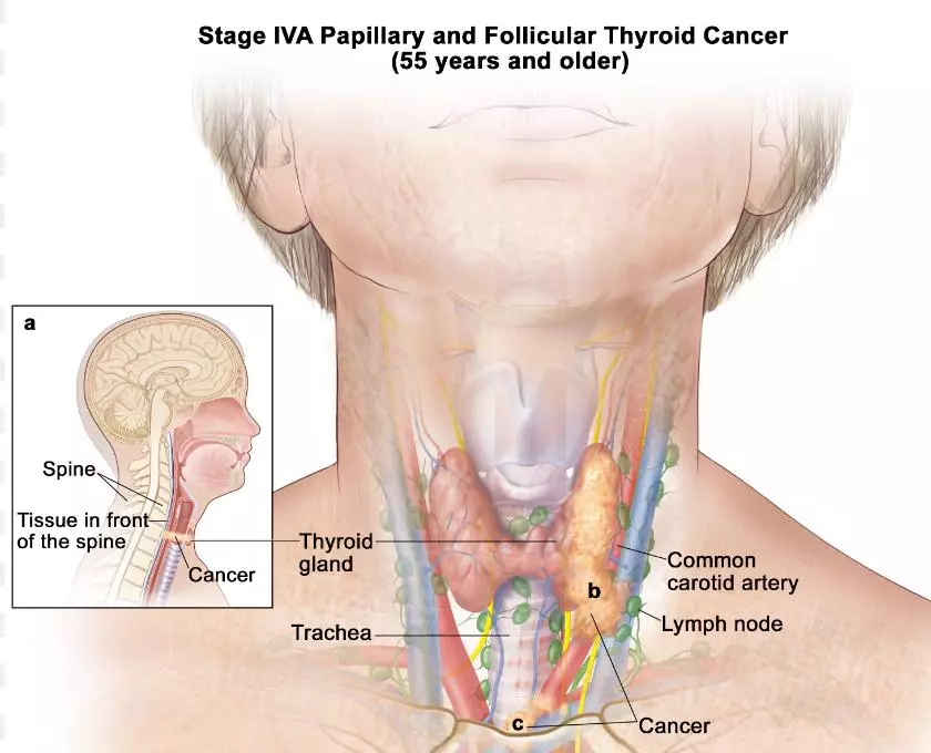 بهترین جراح سرطان تیروئید تهران کیست ؟