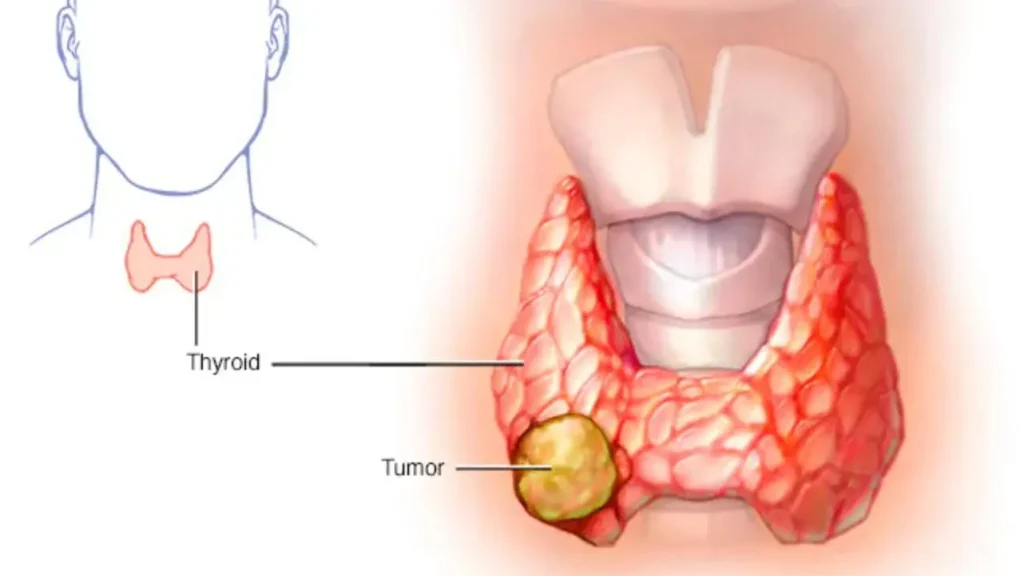 بهترین جراح سرطان تیروئید تهران کیست ؟