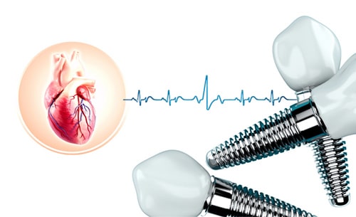 ایمپلنت دندان