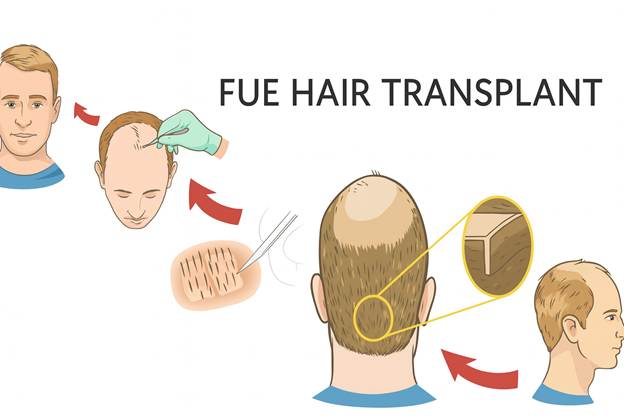 کاشت مو با دستگاه هیرتاس؛ تحول بزرگ در درمان ریزش مو 2