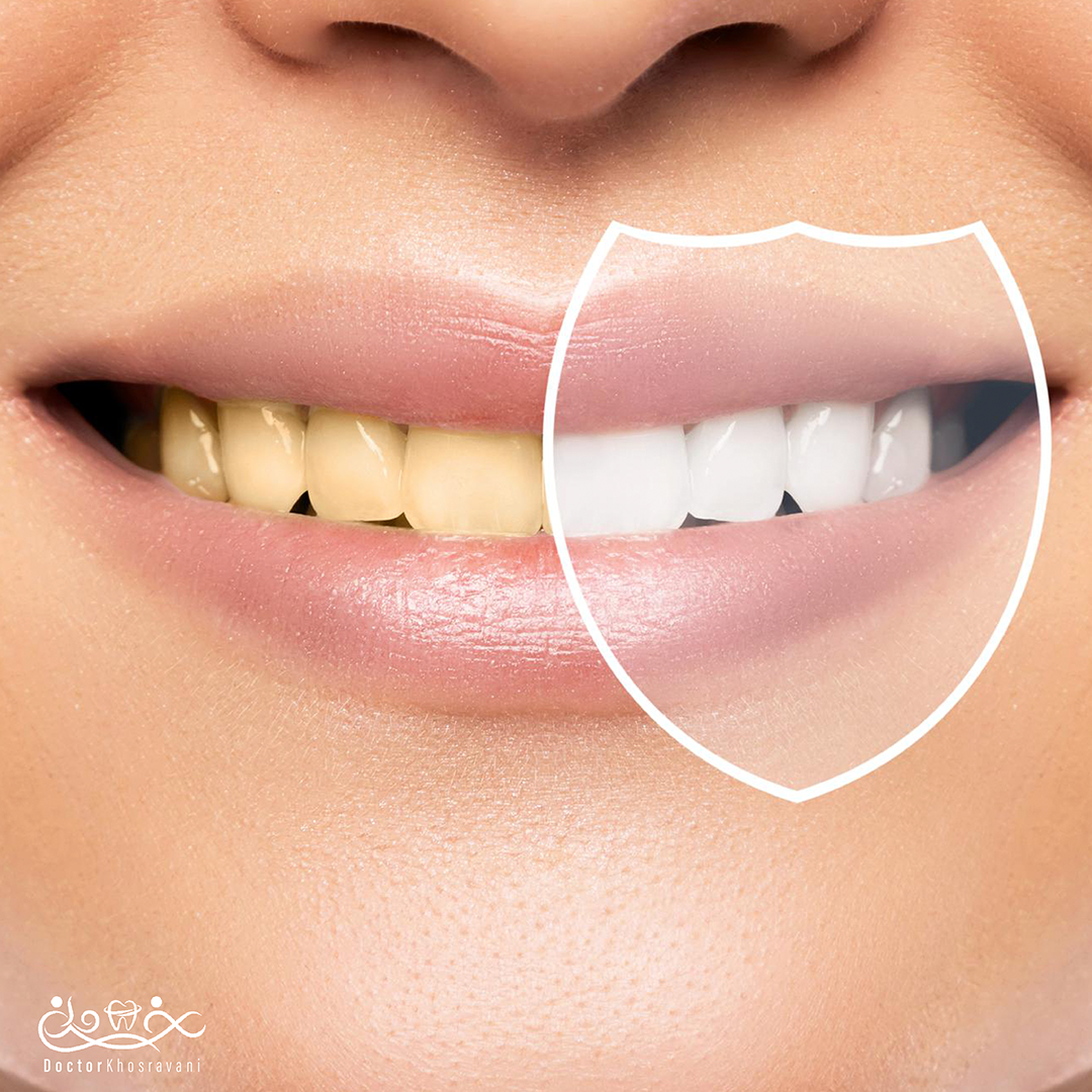 بازیابی سفیدی و درخشندگی دندان ها با بلیچینگ