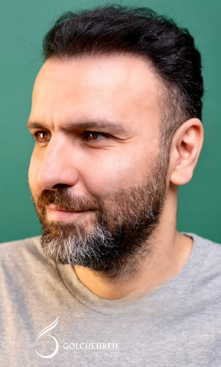 کاشت مو با دستگاه هیرتاس؛ تحول بزرگ در درمان ریزش مو 3