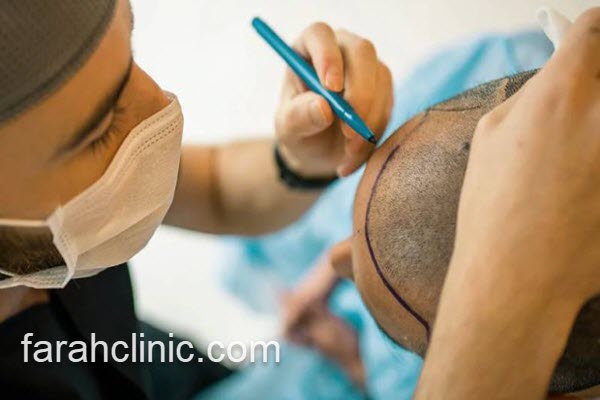 کلینیک کاشت مو در سعادت آباد تهران 3 کاشت موی موفقیت آمیز در فرح کلینیک