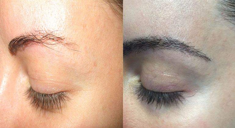 عوارض کاشت ابرو چیست؟ هرآنچه قبل از تصمیمگیری باید بدانید 4 KmmVFtsmJ1TryVqHGOCaTwlwla4t274bwStrC1qr