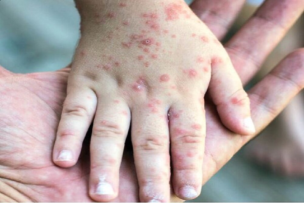 رئیس مرکز بیماری‌های واگیر: افزایش جمعیت حساس عامل اصلی رویداد سرخک است